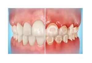 desmineralización dental