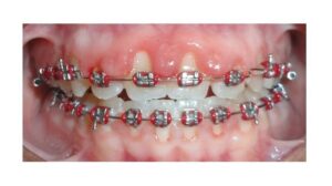 gingivitis brackets