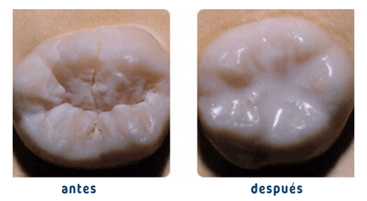 sellador dental