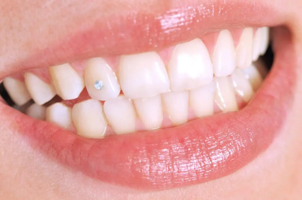 joyería dental