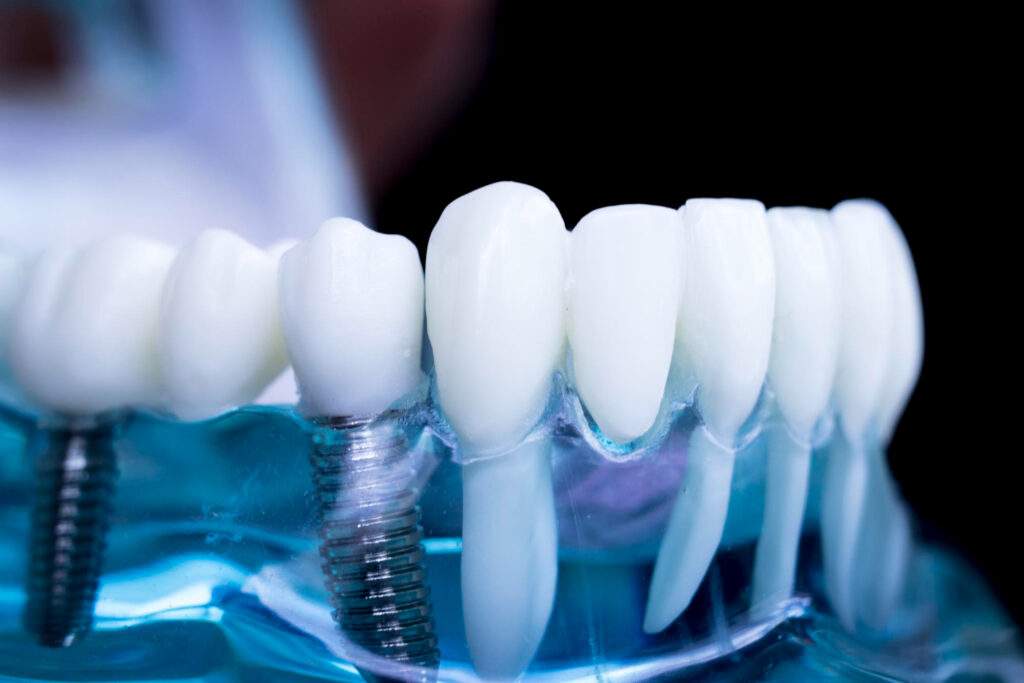 Implantes dentales de carga inmediata: requisitos, fases del tratamiento y resultados esperables
