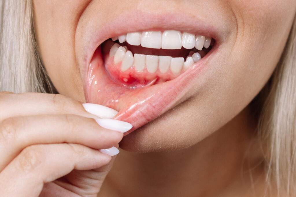 Periodontitis y gingivitis: señales tempranas, tratamientos y cómo evitar que avance
