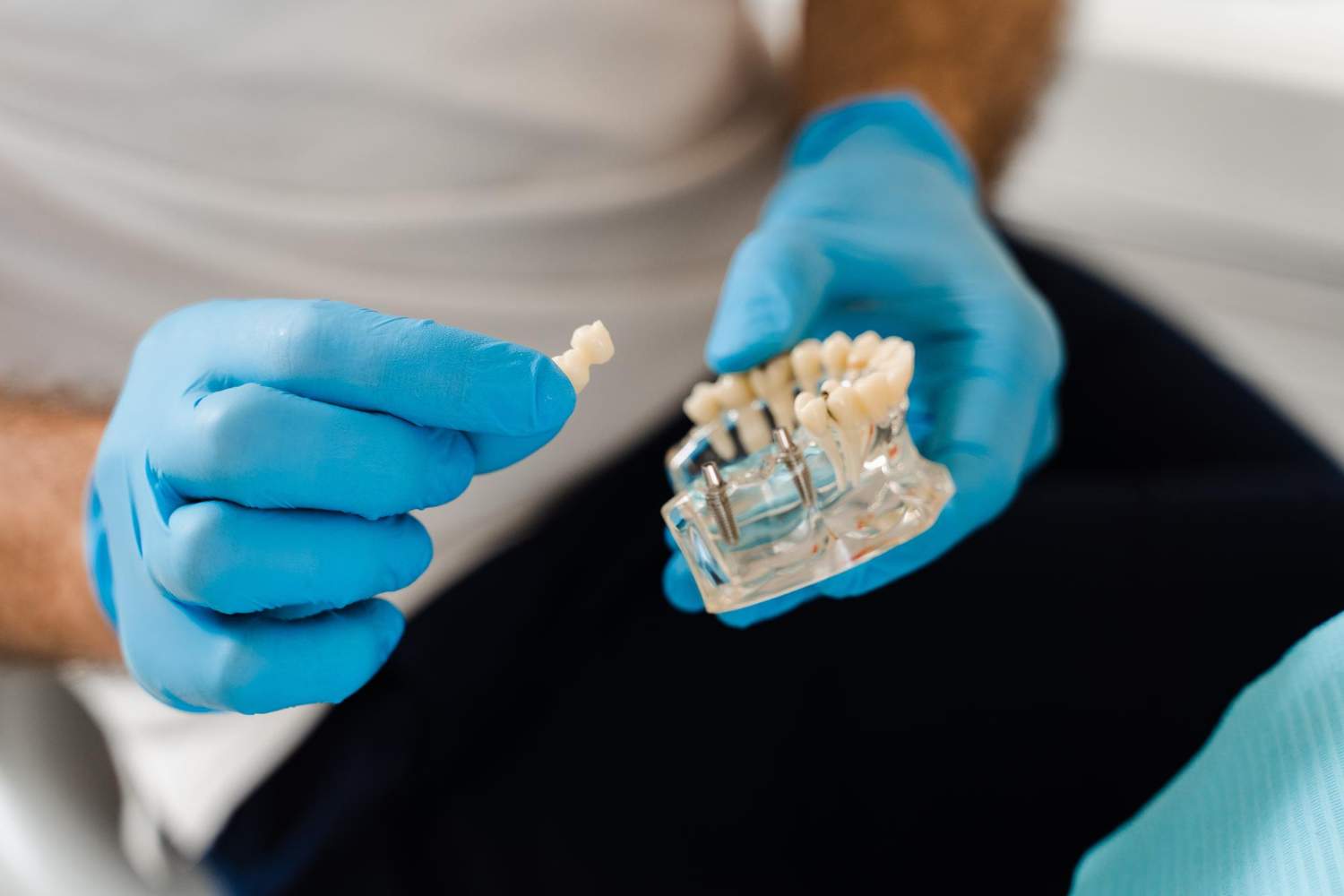 Implantes dentales: qué incluye el precio, materiales y mantenimiento para que duren más