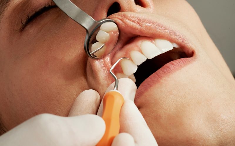 Alveolitis