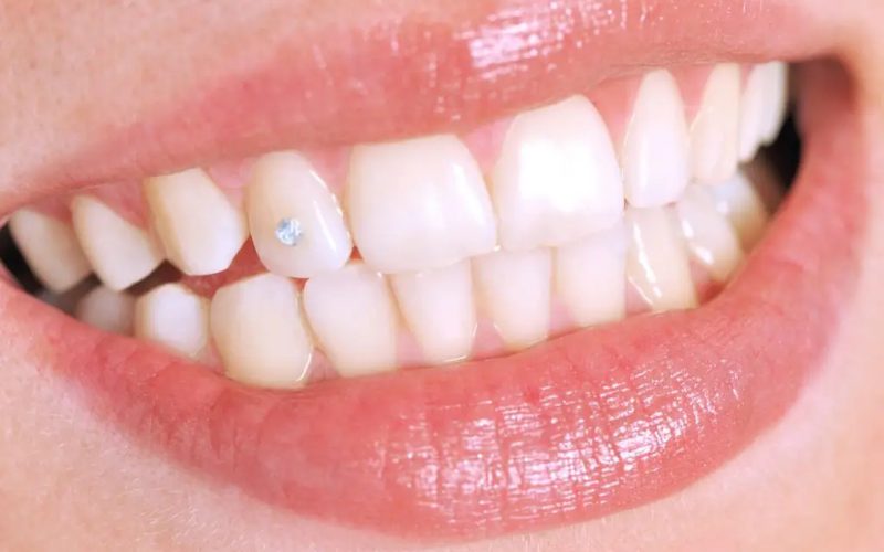 joyería dental